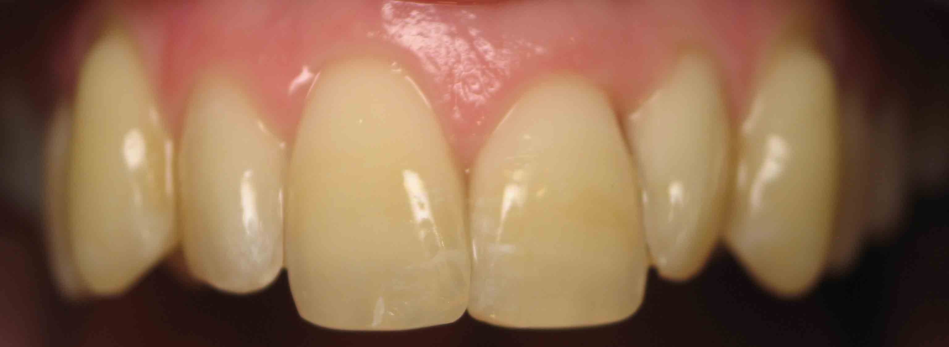 After orthodontic treatment